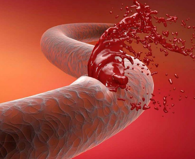 How to Spot Arterial Bleeding